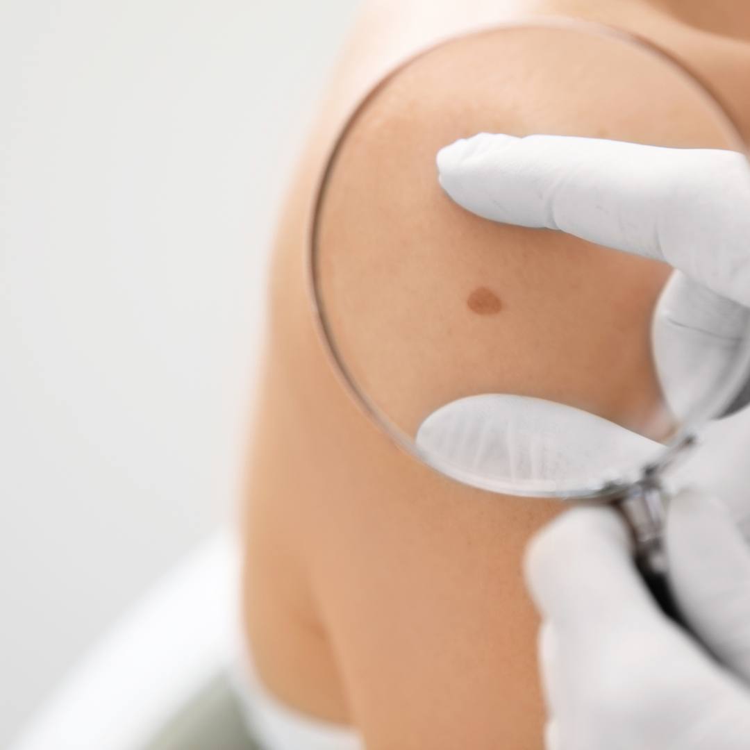 VTCT Level 2 Award in Skin Cancer Awareness